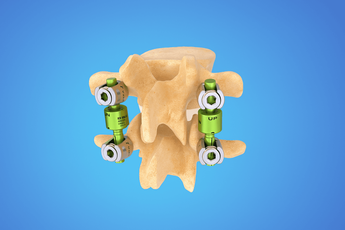 B-Dyn posterior dynamic stabilization system