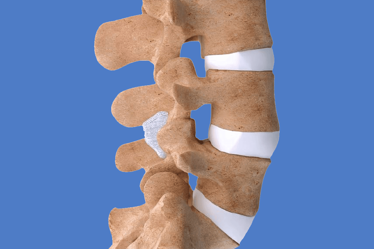 Dispositif interépineux (Intraspine) de stabilisation souple