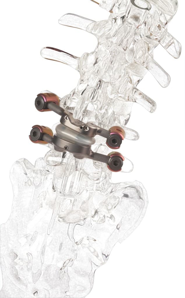 TOPS dynamic stabilization implant in motion